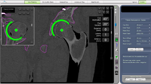 Planning the acetabular component position on the CT scan