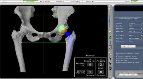  planned hip replacement with correction of anatomy to match the other side