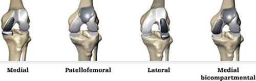 Robotic Partial knee replacement